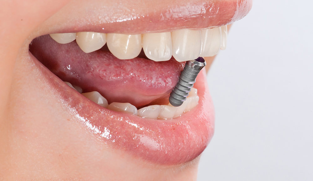 Implantologie Behandlung durch Zahnarzt Noureddine in Oldenburg