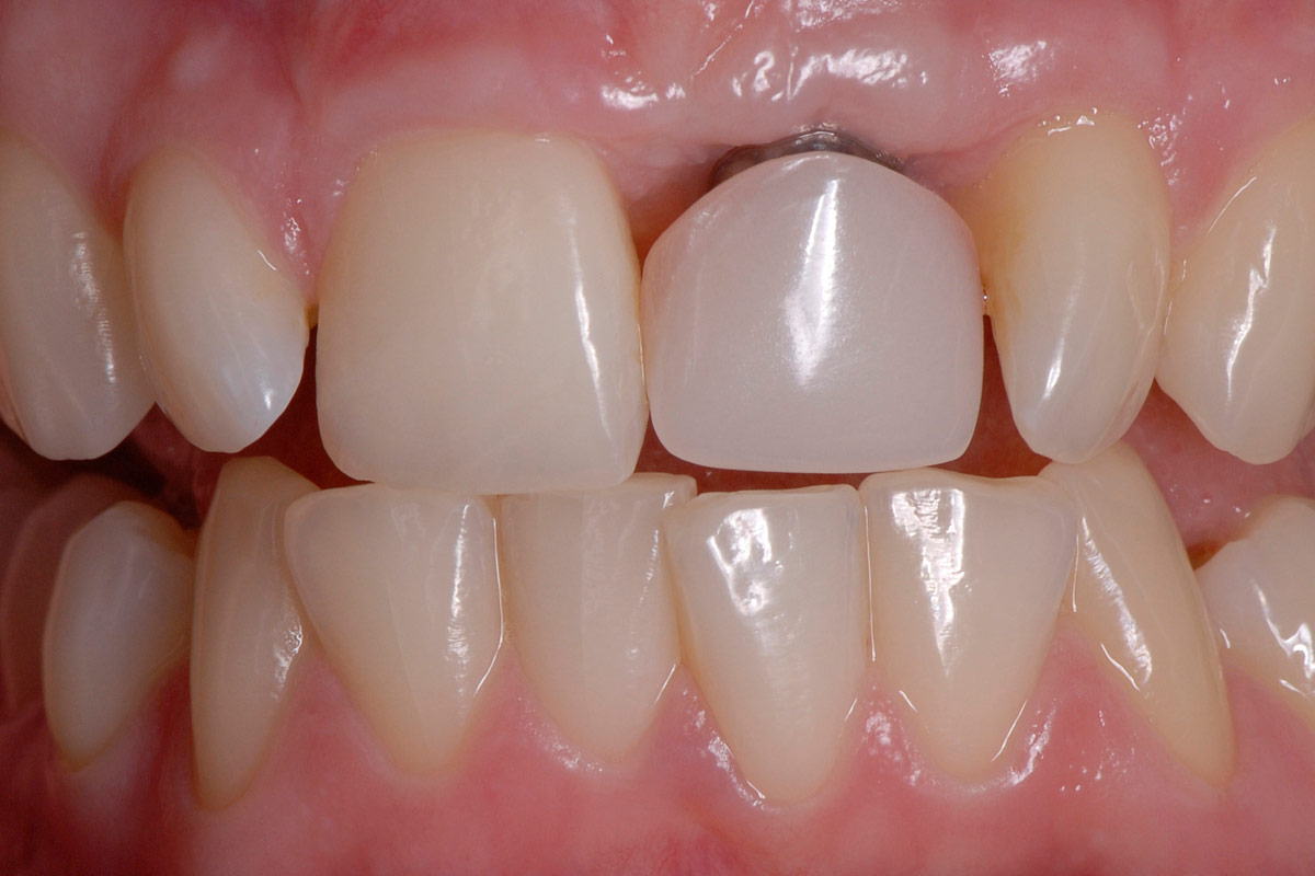 Implantate beim Zahnarzt Oldenburg