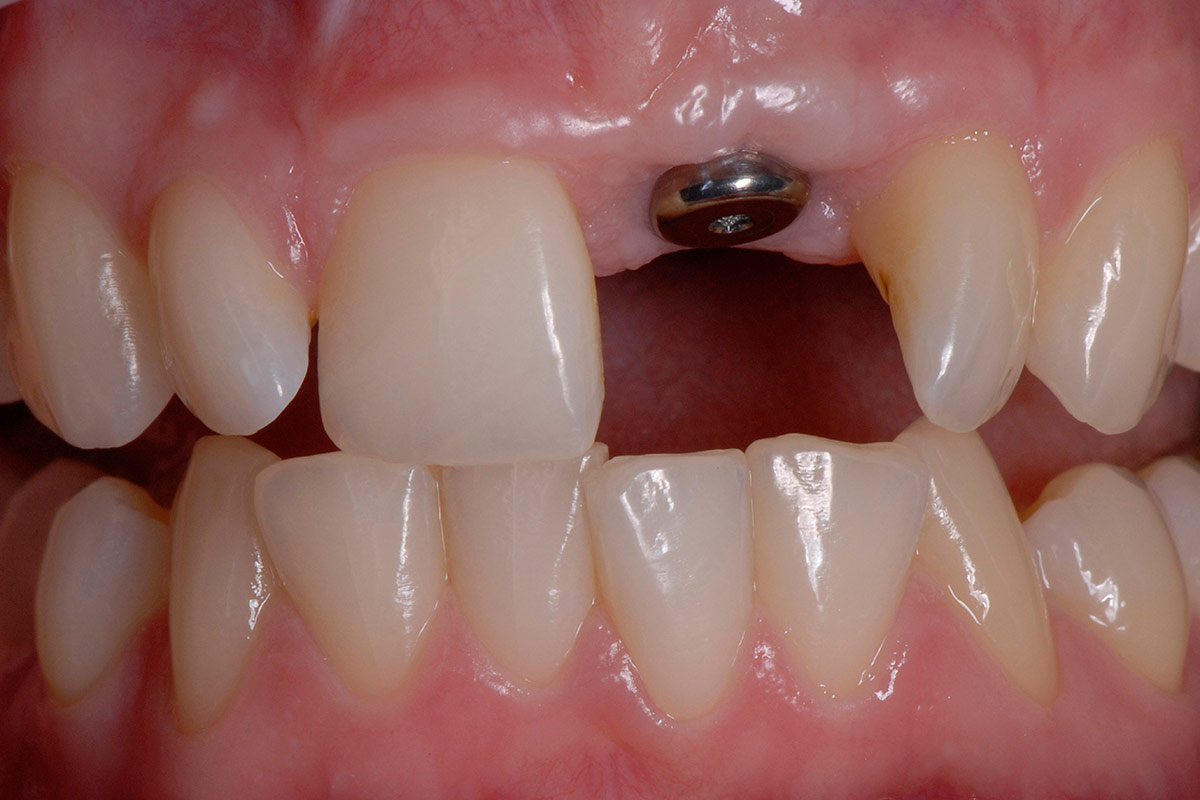 Implantate beim Zahnarzt Oldenburg
