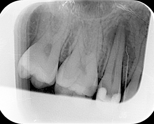 Röntgenbild Zähne Wurzelkanalbehandlung