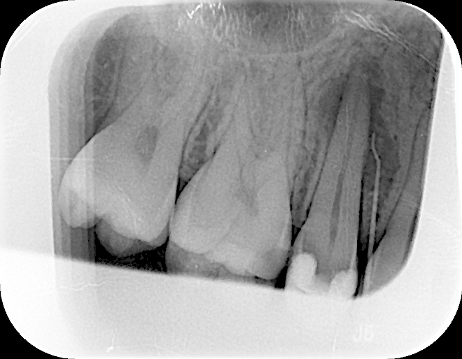 Röntgenbild Zähne Wurzelkanalbehandlung