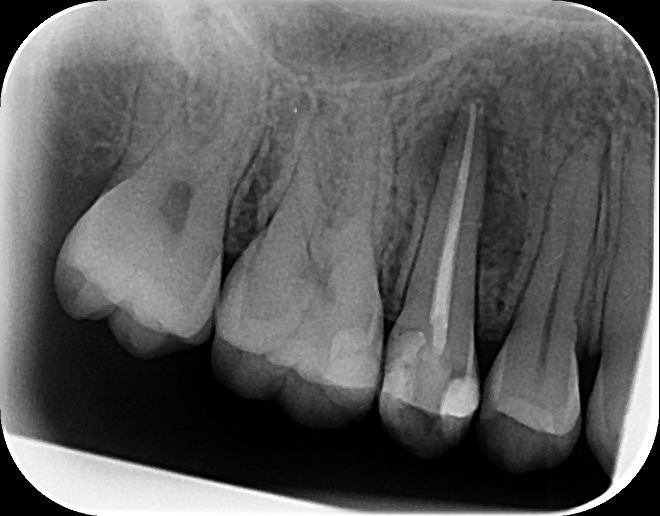 Röntgenbild der Zähne nach Wurzelkanalbehandlung