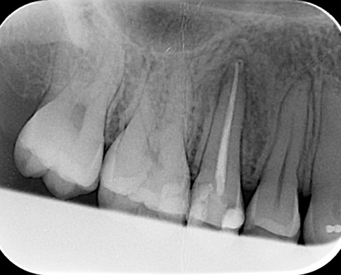 Röntgenbild Zähne Wurzelfüllung