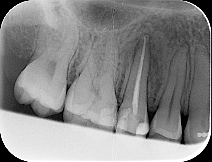 Röntgenbild Zähne Wurzelfüllung