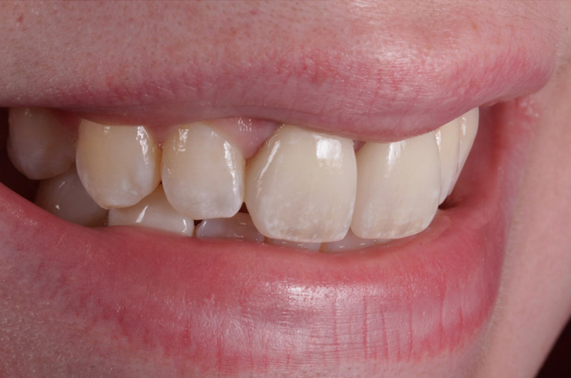 Zahnkronen im Einsatz eines Patienten