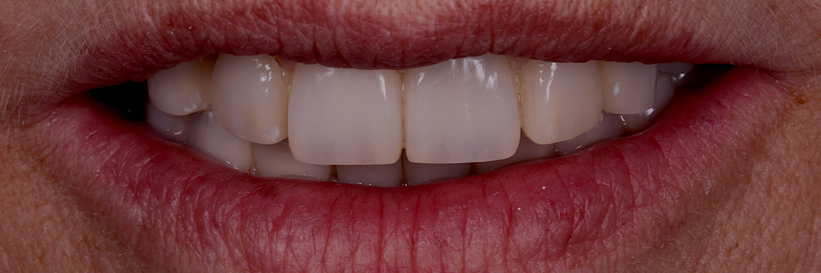 Frontansicht schöner Zähne im Mund einer Patientin