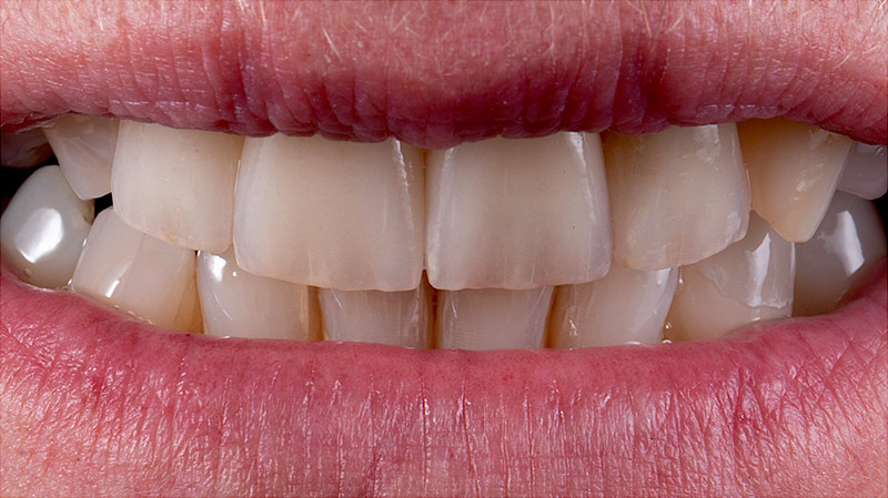 Ansicht einer Zahnprothese im Mund