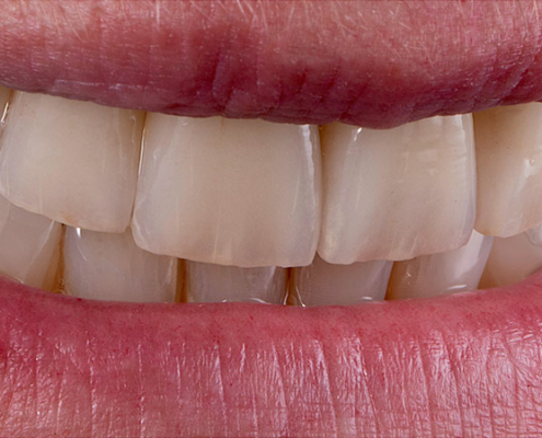 Schöne Zähne Vorderansicht im Mund