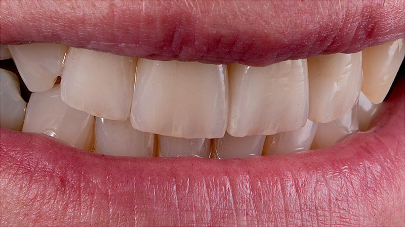 Schöne Zähne Vorderansicht im Mund