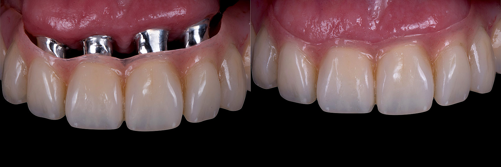 zwei Ansichten einer Befestigung einer Zahnprothese