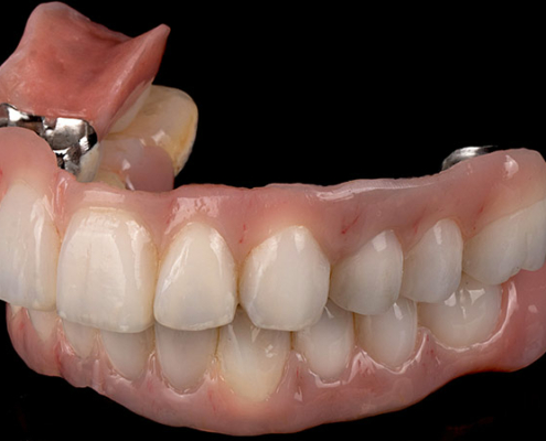 Seitenansicht einer Zahnprothese
