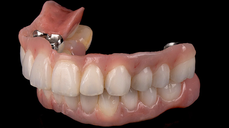 Seitenansicht einer Zahnprothese
