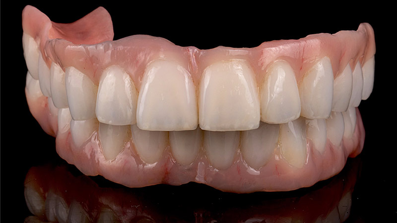Vorderansicht einer Zahnprothese