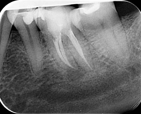 Röntgenbild Zähne