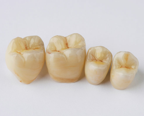 Vier Zähne / Zahnkronen