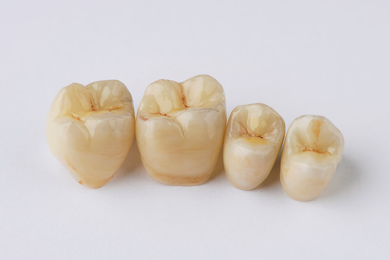 Vier Zähne / Zahnkronen