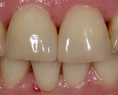 Frontalansicht einzelner Zähne im Mund