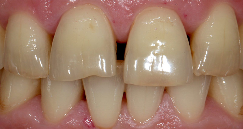 Große Ansicht einzelner Zähne im Frontbereich